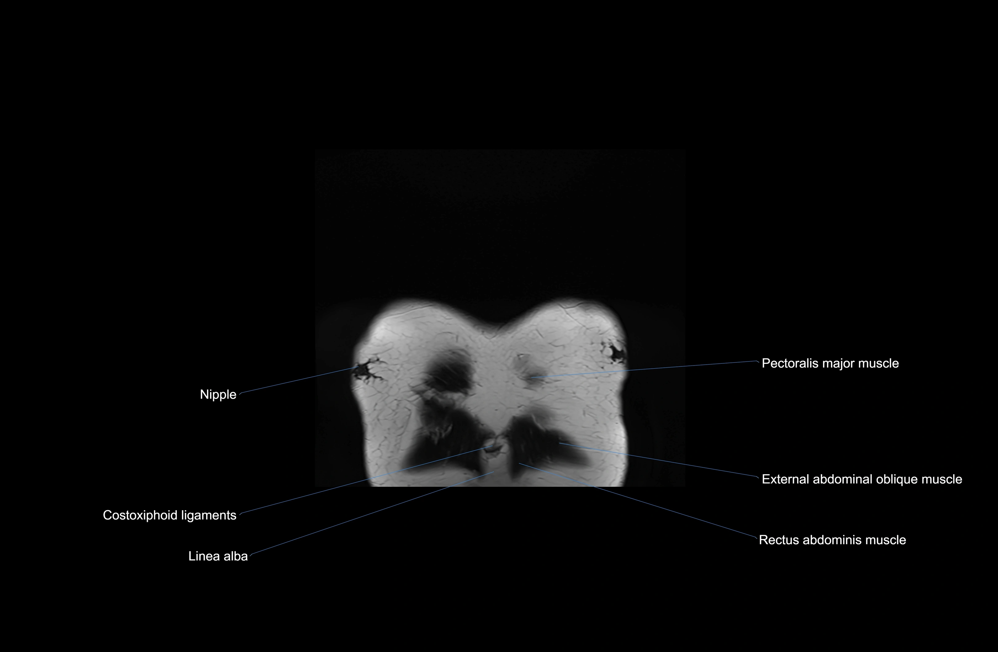 MRI chest (thorax) coronal  cross sectional anatomy 3T radiology  image-img-00001-00002.webp